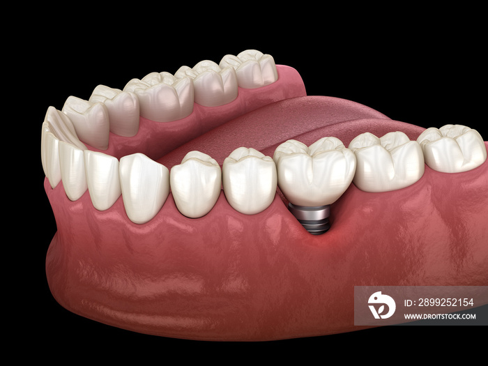 Peri-implantitis with visible gum recession. Medically accurate 3D illustration of dental implants concept