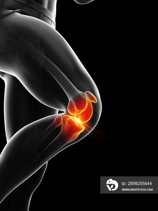 3d rendered medically accurate illustration of a painful knee