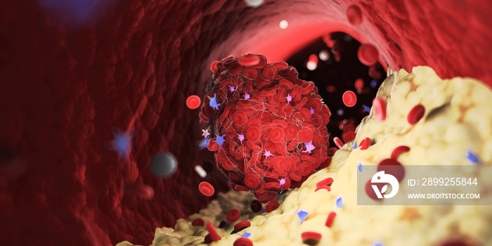 3d rendered medically accurate illustration of a thrombus emerging from a capped plaque