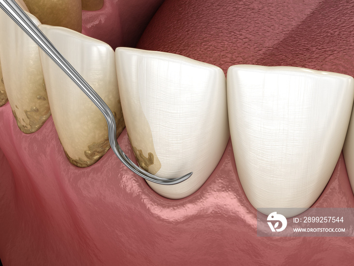 Closed curettage: Scaling and root planing (conventional periodontal therapy). Medically accurate 3D illustration of human teeth treatment