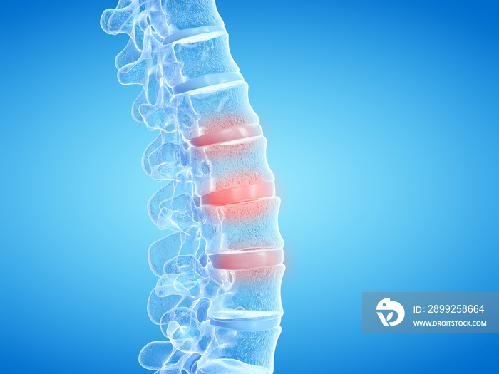 3d rendered medically accurate illustration of painful intervertebral discs