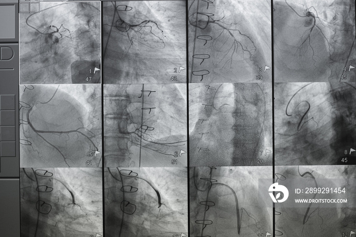 Coronary angiography , left and right coronary angiography