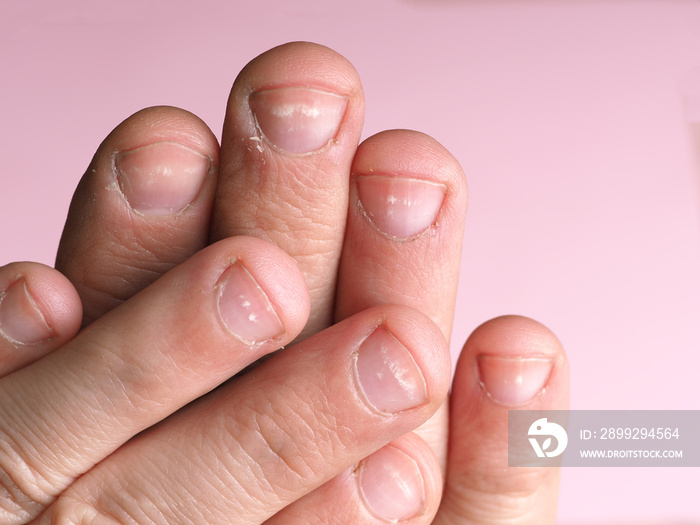 White spots on the nails of the male hand caused by a deficiency of calcium, zinc or poisoning by household chemicals on a pink background. This disease is called leukonychia.