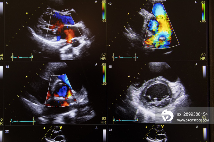 Heart ultrasound image on a computer screen.