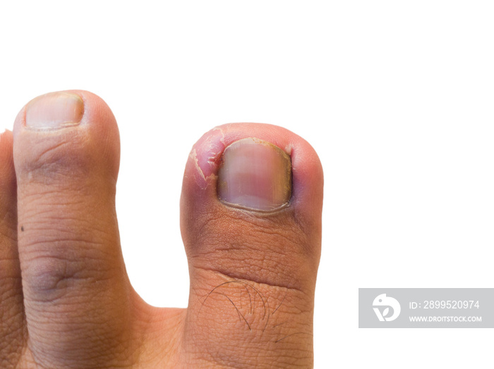 injured big toe due to incorrect cutting of the nail so that the nail pierces the flesh isolated on white background