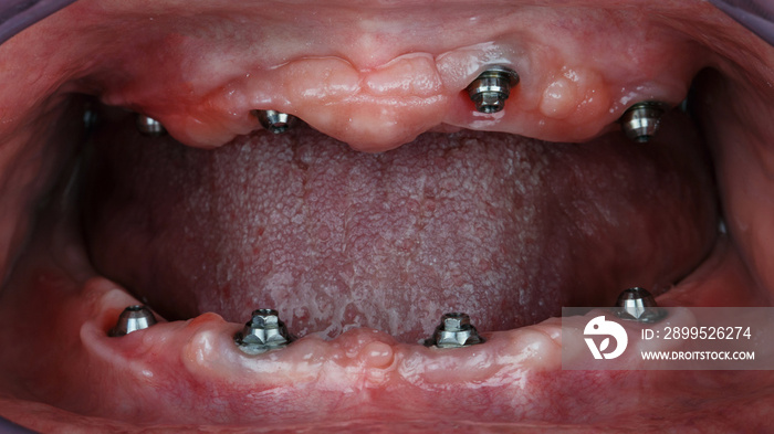 gum cavity before installing prostheses of the upper and lower jaws