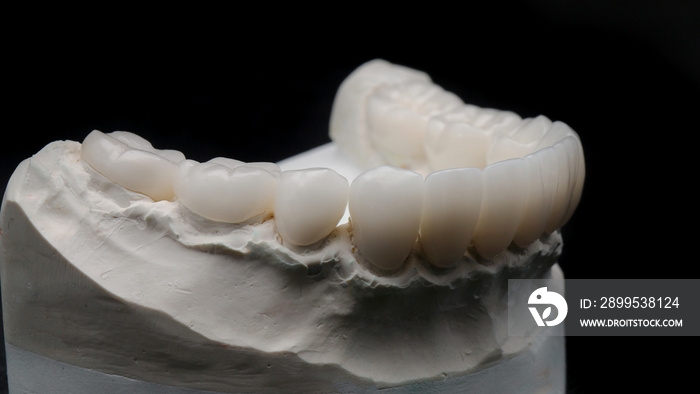 beautiful ceramic crowns for high-quality upper jaw on the model