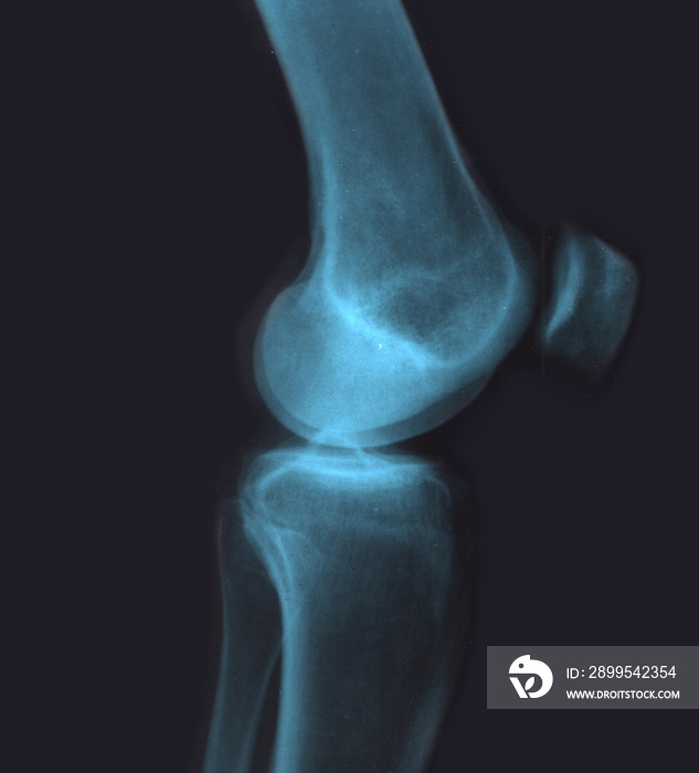 Human knee x-ray. Medical health anatomy diagnostic