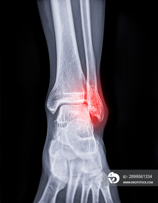 X-ray image of ankle joint showing fracture of ankle joint..