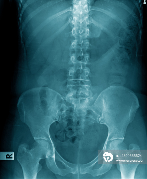 x-ray image of human spine and show lumbar spondylosis