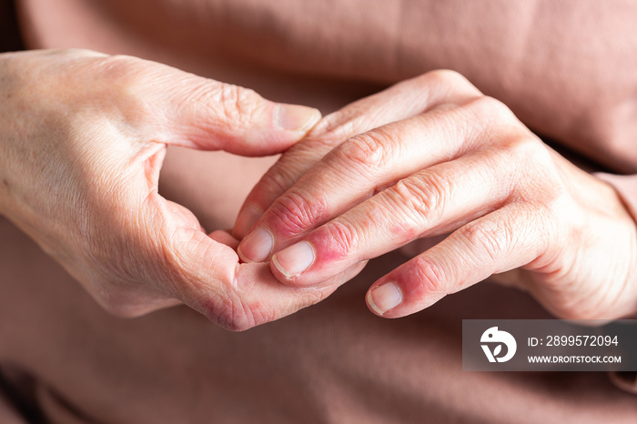 Woman hands with atopic dermatitis, eczema, allergy reaction on skin