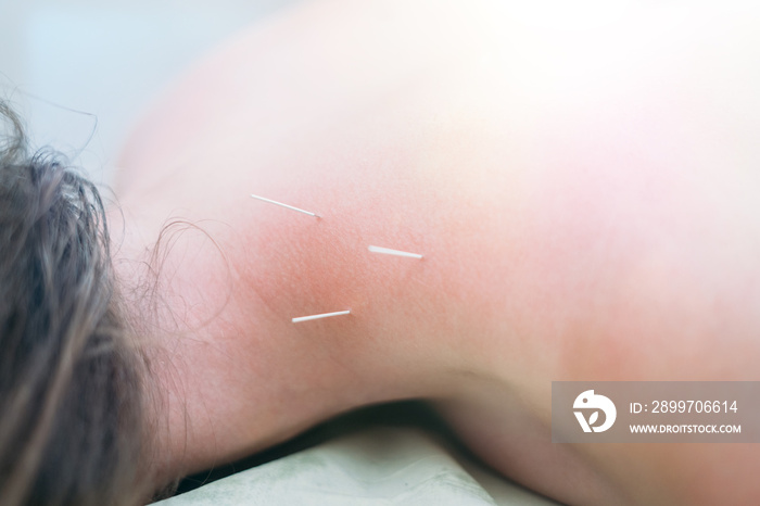 Physiotherapist doing acupuncture to a young woman on her back