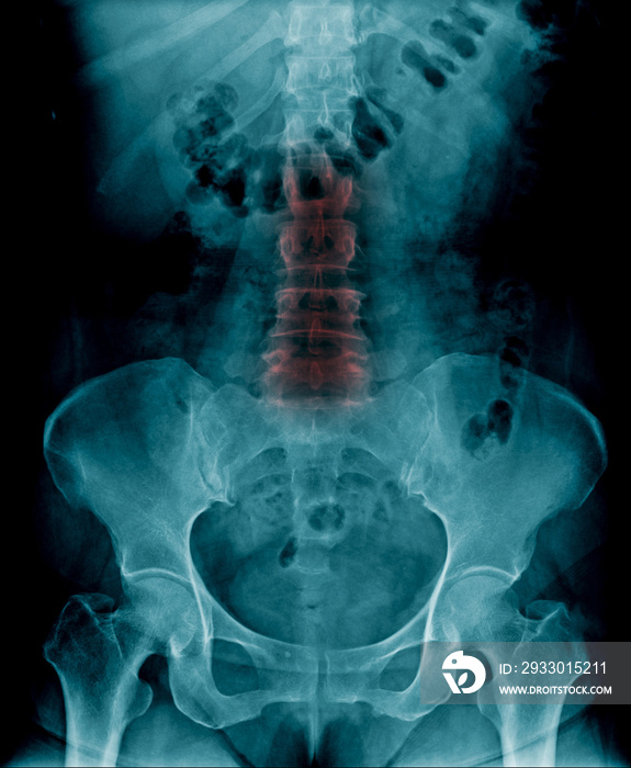 L-spondylosis and degenerative disc of lumbar