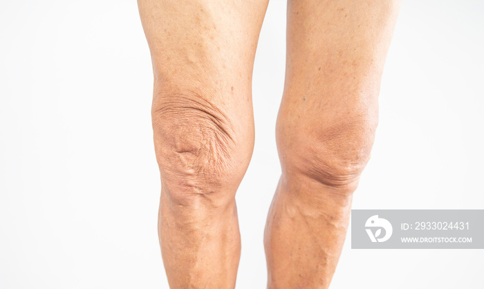 Picture of an elderly man leg with symptom of weak knee joint.