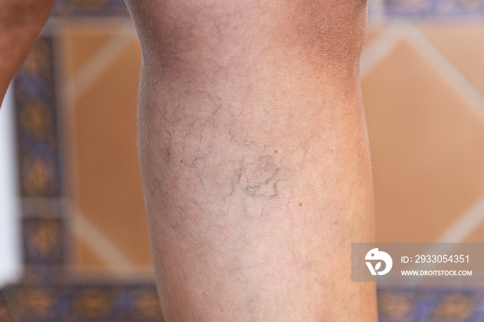 Adult woman’s leg with varicose veins