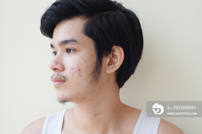 Young man 15 year old. With full face of acne problem or pimple on face Asian young boy