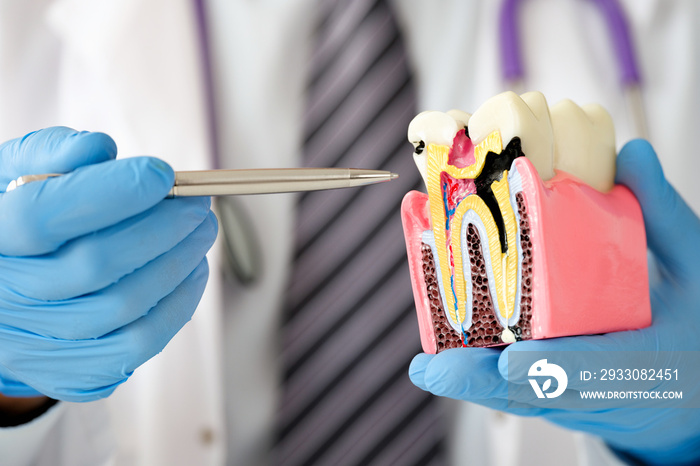 Dentist doctor showing with pen caries on dummy tooth closeup