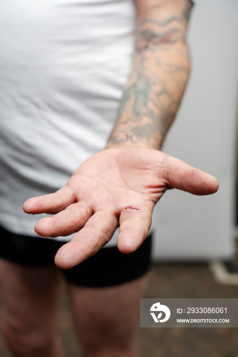 Senior man showing hand with fresh scar