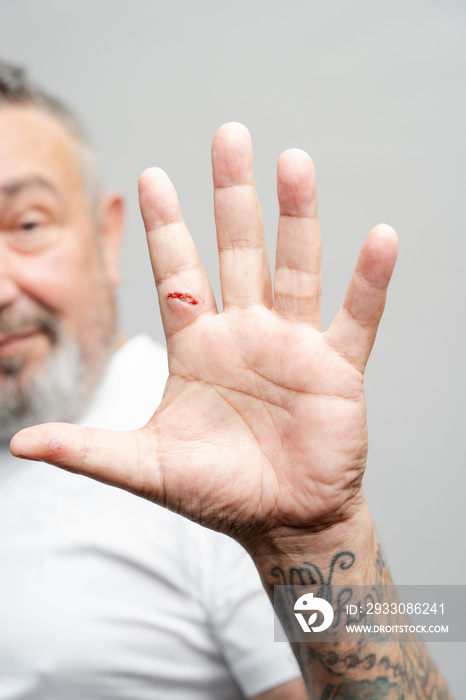 Senior man showing hand with fresh scar