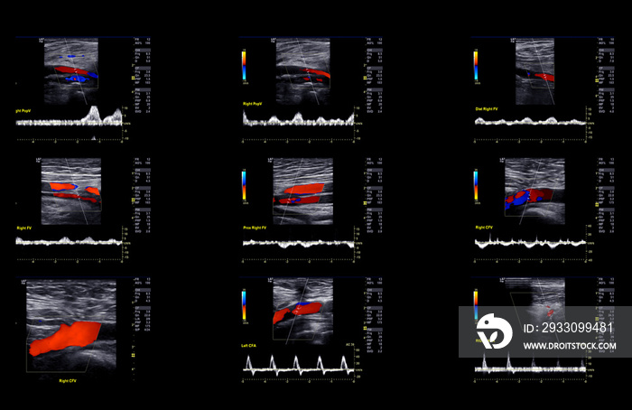 Ultrasound doppler for finding  deep vein thrombosis of lower extremity.