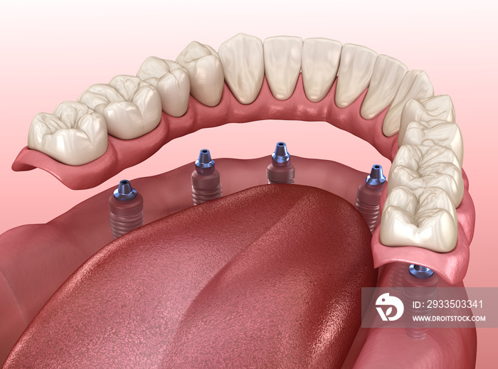 Mandibular prosthesis with gum All on 6 system supported by implants.  Medically accurate 3D illustration of human teeth and dentures concept