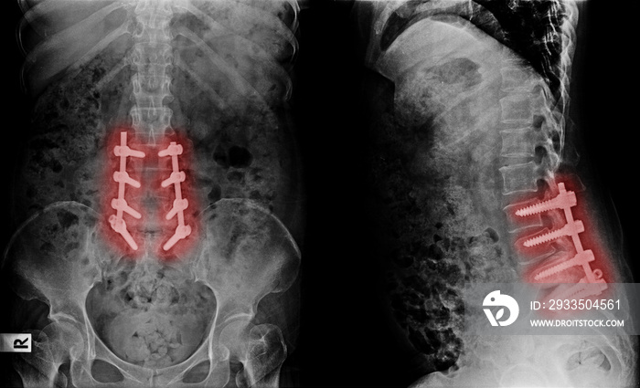 X-ray image of lumbar spine postoperative treatment for degenerative lumbar disc disease by decompression and fix by iron rod and screws
