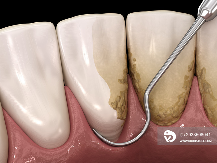 Oral hygiene: Scaling and root planing (conventional periodontal therapy). Medically accurate 3D illustration of human teeth treatment