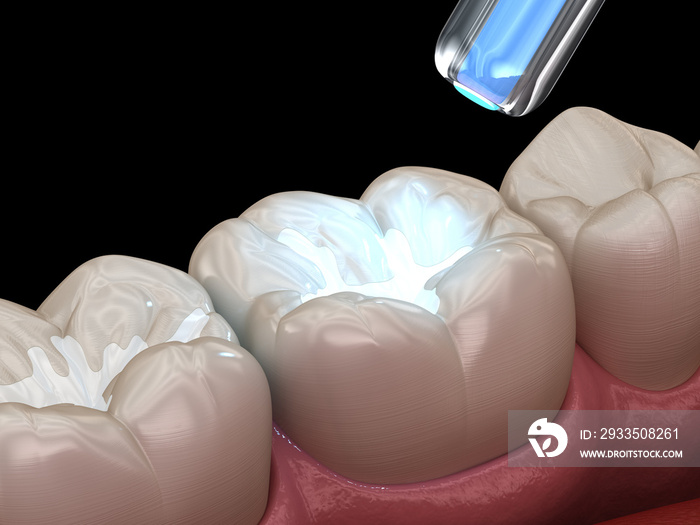 Tooth restoration with filling and polymerization lamp. Medically accurate tooth 3D illustration.