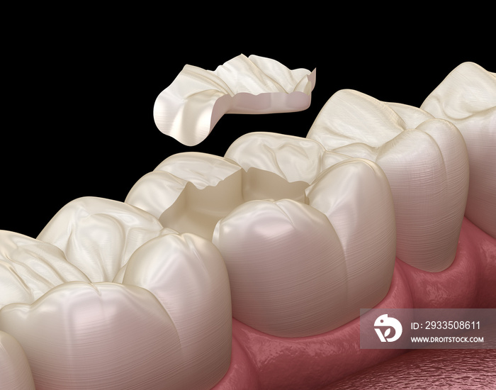 Inlay ceramic crown fixation over tooth. Medically accurate 3D illustration of human teeth treatment