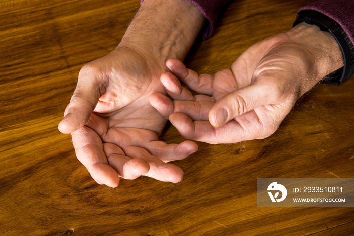 The hands of a male with Psoriatic Arthritis showing deviation of the Ulnar metacarpal joints.