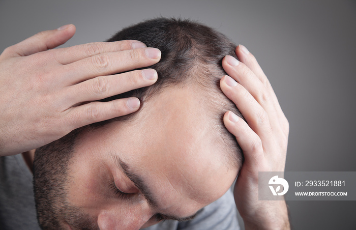 Caucasian man checking his hair. Hair loss problem