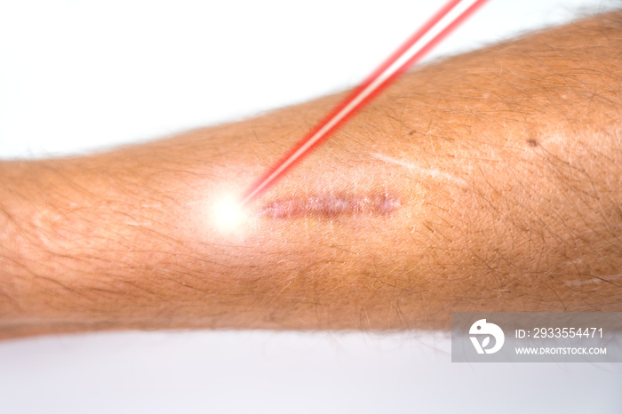 Man leg and laser beam during scar removal treatment. Laser resurfacing of scars , laser surgery. Skincare in cosmetology clinic