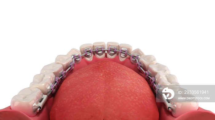 Lingual braces system on a demonstration denture 3d on white