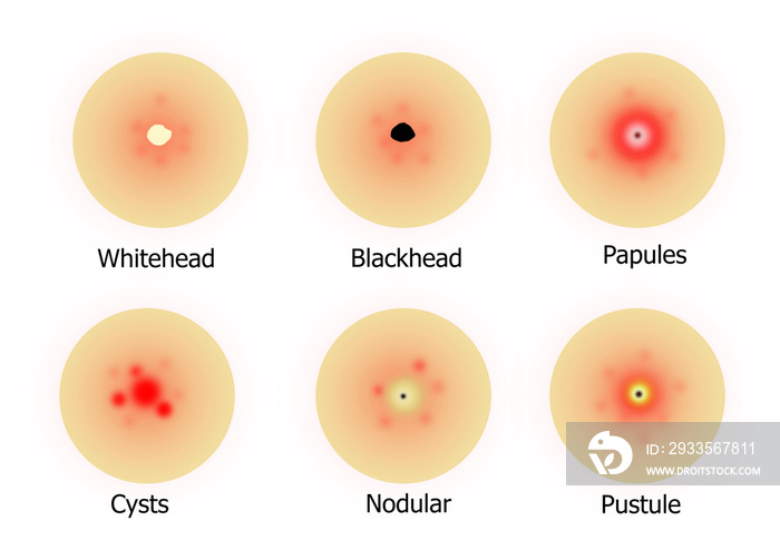 Types of acne on the face