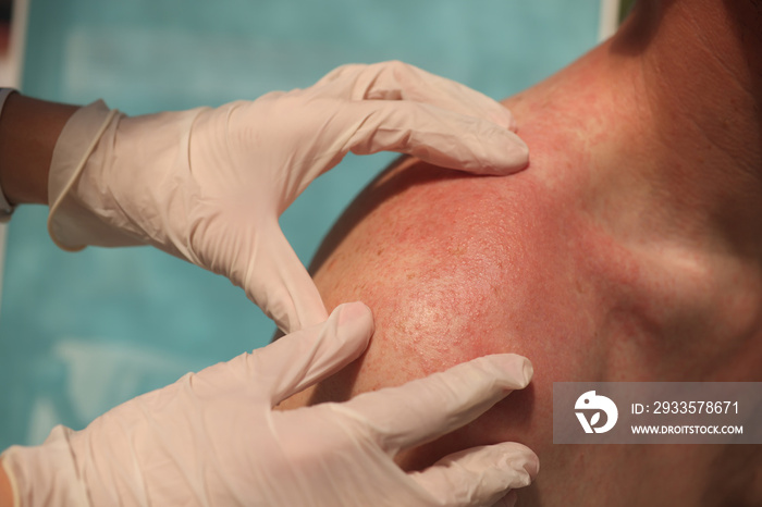 Doctor dermatologist examining rash on skin of man shoulders using gloves closeup