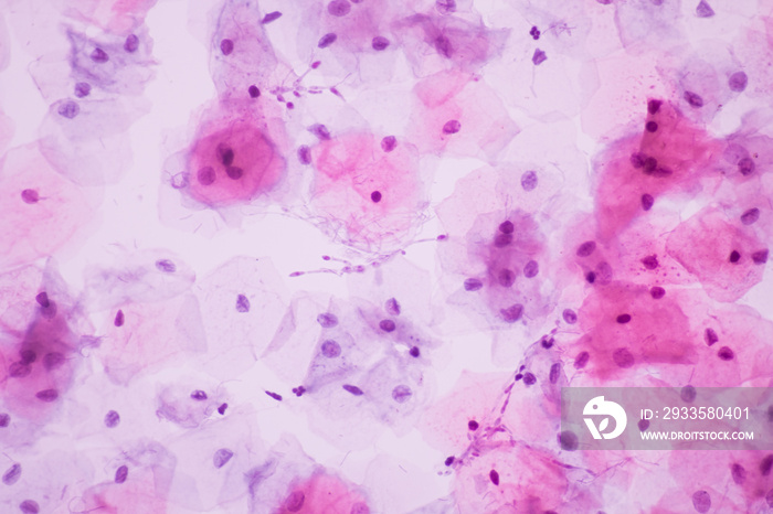 View in microscopic of Candidiasis, fungus infection (Yeast and Pseudohyphae form) in pap smear slide cytology and diagnostic by pathologist.Gynecology report and diagnosis.Medical concept.