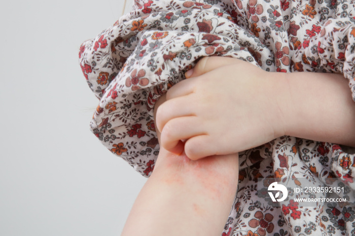 Toddler girl suffering from atopic dermatitis, close up image. Red and itchy skin. Eczema on kid’s arm.