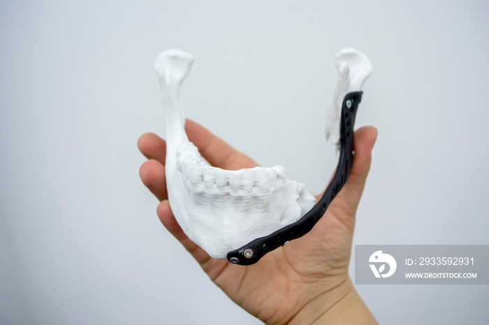 Person holding in hand 3D printed plastic prototype human lower jaw and medical titanium implant close-up. Prosthesis anatomical bone 3D printed from metal powder. Orthopedic maxillo-facial prosthesis