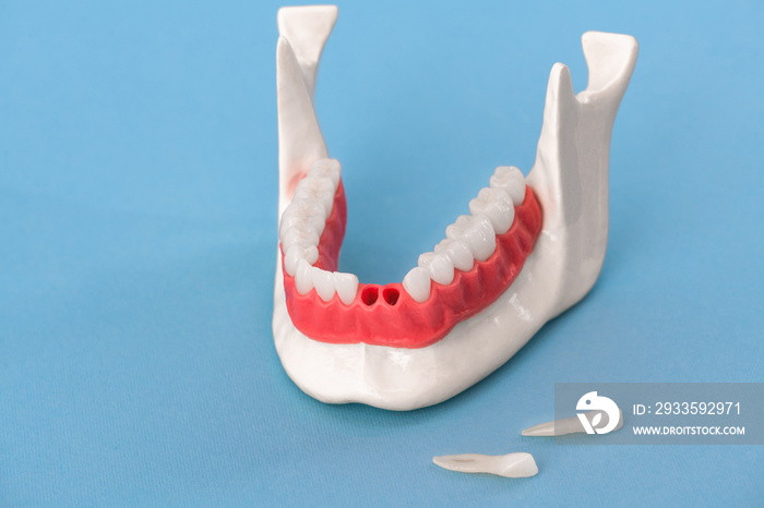 Teeth implant and crown installation process parts isolated on a blue background. Medically accurate 3D model.