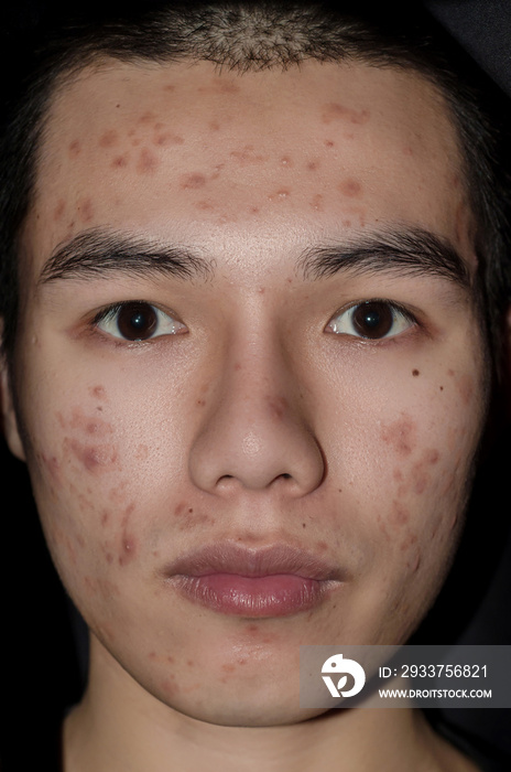 The scars and wrinkle caused by acne and pimple on skin by Hormone or grime.