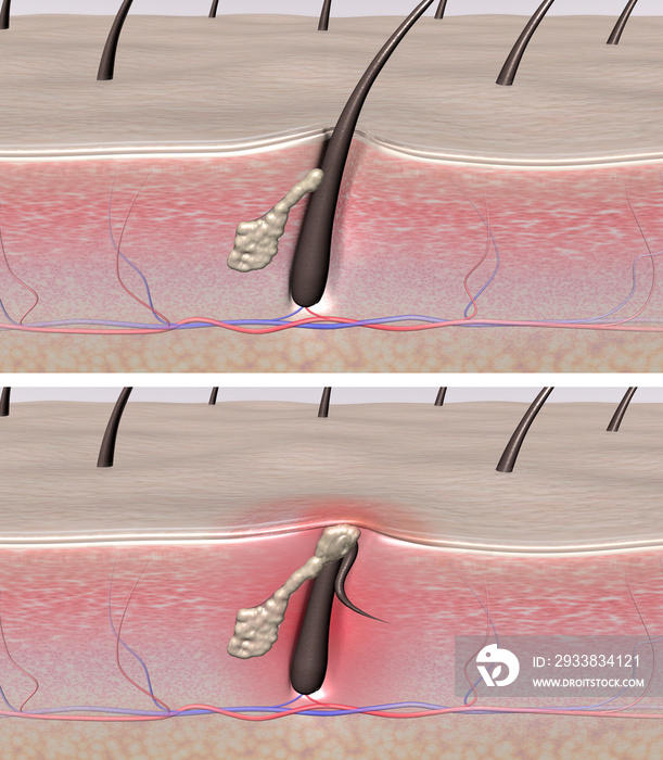 Normal and problem skin. 3D render of human skin cross-sections showing healthy hair follicles and i