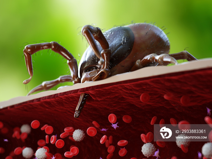 3d rendered illustration showing the sting of a tick penetrating a human artery