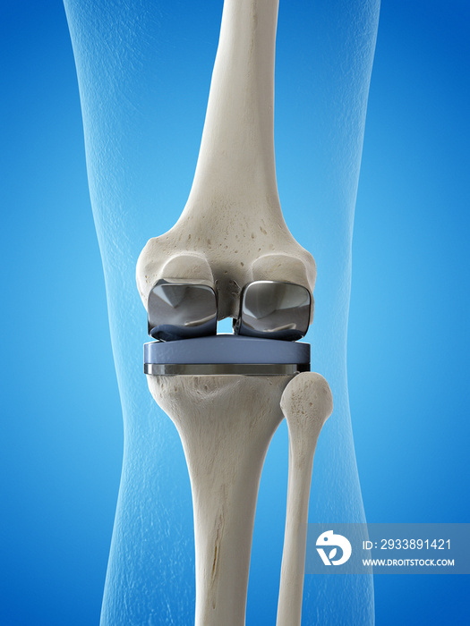 膝关节置换术的三维医学精确图示
