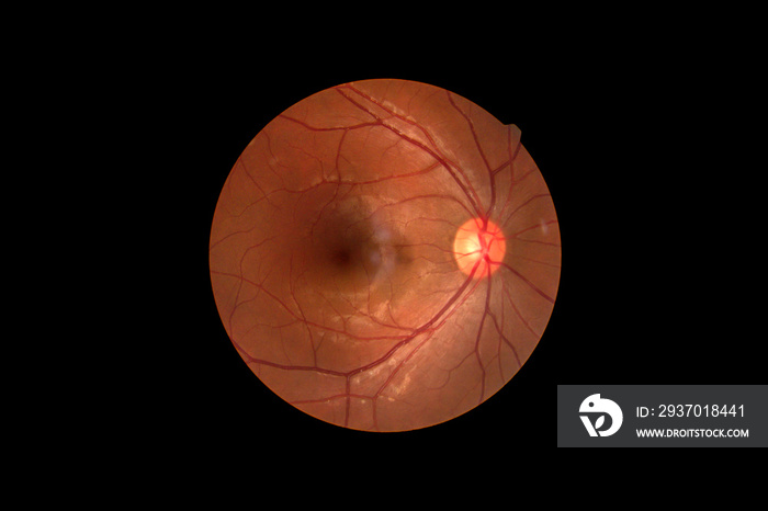 照片疯狂视网膜异常分离于黑色背景。糖尿病糖尿病视网膜病变