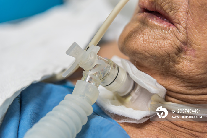 患者在医院做气管造口术和呼吸机
