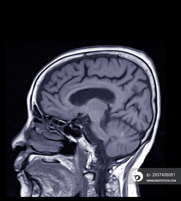 大脑矢状面的比较MRI，用于检测大脑的各种状况，如c