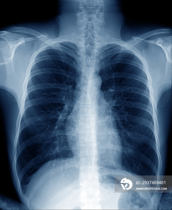 正常健康男性胸部x线片显示肺部、心脏、脊椎、锁骨、横膈膜