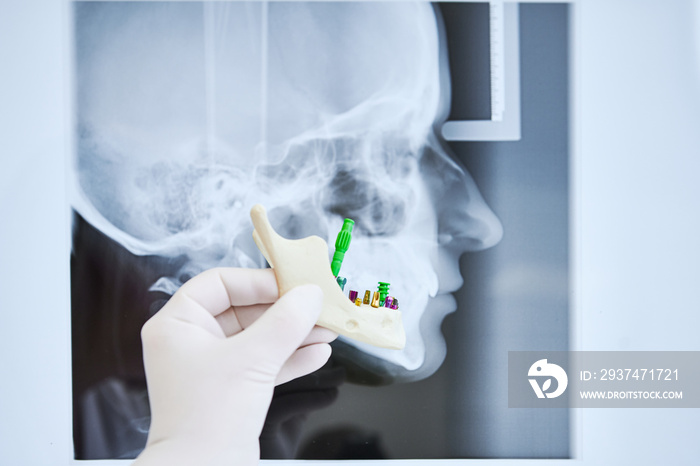 Dentist implantologist showing dental implant technology on human tooth jaw model