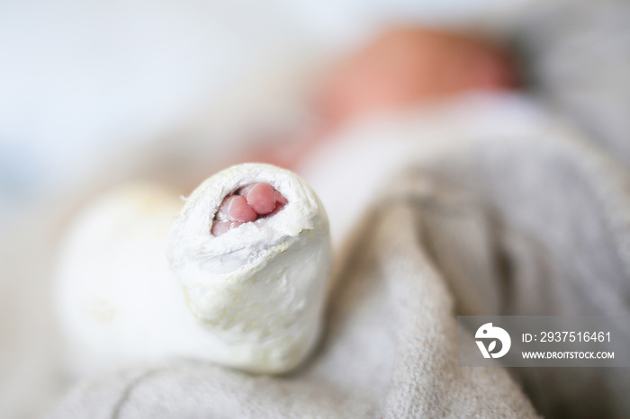 Closeup of newborn little baby with leg in a cast - clubfoot