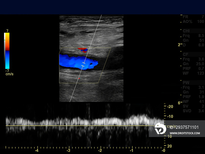 Ultrasound doppler of femoral vien for finding  deep vein thrombosis or DVT.